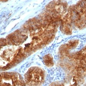 Monoclonal anti TAG 72 / CA72.4 (B72.3 + CC49)