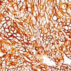Formalin-fixed paraffin-embedded human Colon Carcinoma stained with Cytokeratin 18 Mouse Monoclonal Antibody (DA7).