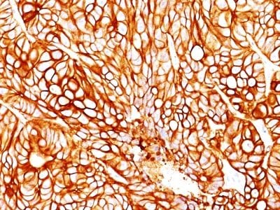 Formalin-fixed paraffin-embedded human Colon Carcinoma stained with Cytokeratin 18 Mouse Monoclonal Antibody (DA7).