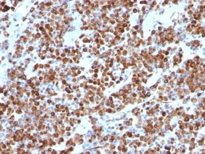 Formalin-fixed paraffin-embedded human Melanoma stained with Vimentin Mouse Monoclonal Antibody (VM452).