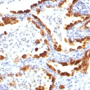 Formalin-fixed paraffin-embedded human Lung Cancer stained with Cytokeratin 18 Mouse Monoclonal Antibody (KRT18/835).