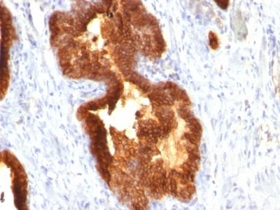 Formalin-fixed paraffin-embedded human Prostate Cancer stained with Cytokeratin 18 Mouse Monoclonal Antibody (KRT18/835).