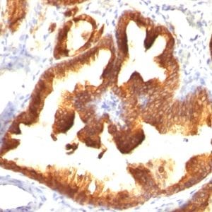 Formalin-fixed paraffin-embedded human Prostate Carcinoma stained with  Cytokeratin 18 Mouse Monoclonal Antibody (KRT18/836).