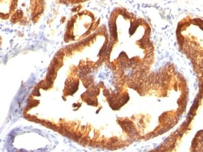 Formalin-fixed paraffin-embedded human Prostate Carcinoma stained with  Cytokeratin 18 Mouse Monoclonal Antibody (KRT18/836).