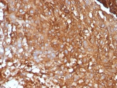 Formalin-fixed paraffin-embedded human Melanoma stained with Beta-2-Microglobulin Monoclonal Antibody (B2M/961).