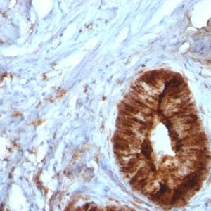 Formalin-fixed paraffin-embedded human Cervical Carcinoma stained with Beta-2-Microglobulin Monoclonal Antibody (B2M/961).