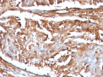 Formalin-fixed paraffin-embedded human Renal Carcinoma stained with Beta-2-Microglobulin Monoclonal Antibody (B2M/961)