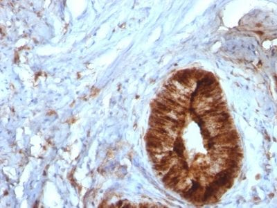 Formalin-fixed paraffin-embedded human Cervical Carcinoma stained with Beta-2-Microglobulin Monoclonal Antibody (B2M/961).