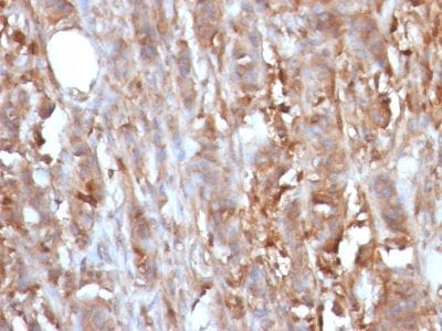 Formalin-fixed paraffin-embedded human Renal Cell Carcinoma Stained with Beta-2-Microglobulin Mouse Monoclonal Antibody (B2M/961).