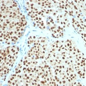 Formalin-fixed paraffin-embedded Human Melanoma stained with SOX10 Mouse Monoclonal Antibody (SOX10/991).