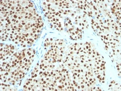 Formalin-fixed paraffin-embedded Human Melanoma stained with SOX10 Mouse Monoclonal Antibody (SOX10/991).