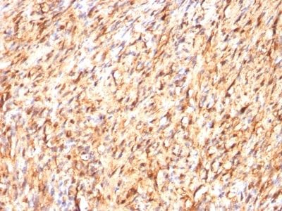 Formalin-fixed paraffin-embedded human Schwanoma stained with S100B Mouse Monoclonal Antibody (S100B/1012).