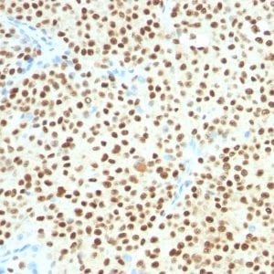 Formalin-fixed paraffin-embedded Human Melanoma stained with SOX10 Mouse Monoclonal Antibody (SOX10/1074).