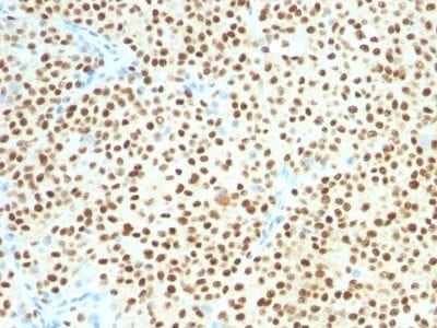 Formalin-fixed paraffin-embedded Human Melanoma stained with SOX10 Mouse Monoclonal Antibody (SOX10/1074).