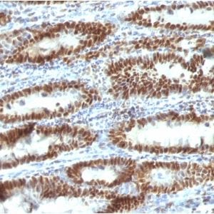 Formalin-fixed paraffin-embedded human Gastric Carcinoma stained with TOX3 Mouse Monoclonal Antibody (TOX3/1123).