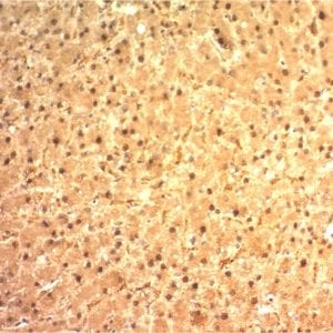 Formalin-fixed paraffin-embedded human Hepatocellular Carcinoma stained with ARG 1 Mouse Monoclonal Antibody (ARG1/1125).