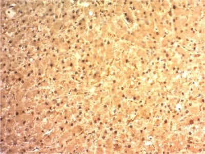 Formalin-fixed paraffin-embedded human Hepatocellular Carcinoma stained with ARG 1 Mouse Monoclonal Antibody (ARG1/1125).