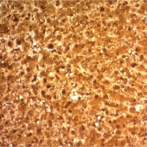 Formalin-fixed paraffin-embedded human Hepatocellular Carcinoma stained with ARG 1 Mouse Monoclonal Antibody (ARG1/1126).