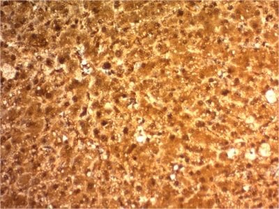 Formalin-fixed paraffin-embedded human Hepatocellular Carcinoma stained with ARG 1 Mouse Monoclonal Antibody (ARG1/1126).