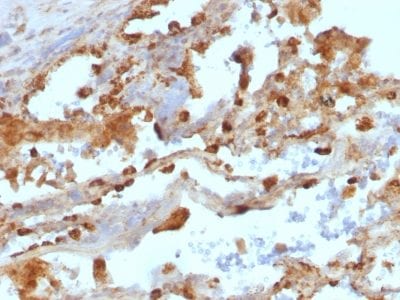 Formalin-fixed paraffin-embedded human Lung Carcinoma stained with CD11c Mouse Monoclonal Antibody (ITGAX/1243).