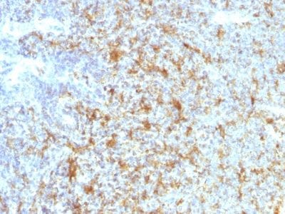Formalin-fixed paraffin-embedded human Follicular Lymphoma stained with CD11c Mouse Monoclonal Antibody (ITGAX/1243).
