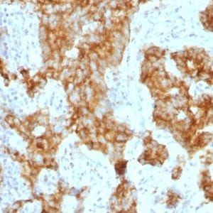 Formalin-fixed paraffin-embedded human Prostate Carcinoma stained with CD11c Mouse Monoclonal Antibody (ITGAX/1243).