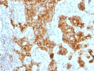 Formalin-fixed paraffin-embedded human Prostate Carcinoma stained with CD11c Mouse Monoclonal Antibody (ITGAX/1243).