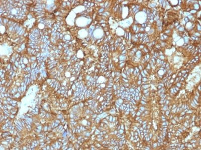 Formalin-fixed paraffin-embedded Human Hepatocellular Carcinoma stained with EpCAM Mouse Monoclonal Antibody (EGP40/1372).