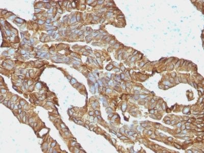 Formalin-fixed paraffin-embedded Human Colorectal Carcinoma stained with EpCAM Monoclonal Antibody (EGP40/1372).