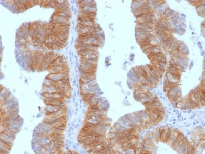 Formalin-fixed paraffin-embedded Human Ovarian Carcinoma stained with EpCAM Mouse Monoclonal Antibody (EGP40/1384).