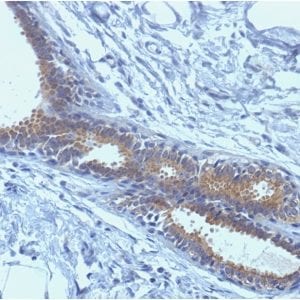 Formalin-fixed paraffin-embedded human Breast Carcinoma Stained with BRCA1 Mouse Monoclonal Antibody (BRCA1/1398).