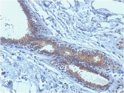 Formalin-fixed paraffin-embedded human Breast Carcinoma Stained with BRCA1 Mouse Monoclonal Antibody (BRCA1/1398).