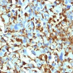 Formalin-fixed paraffin-embedded human Histiocytoma stained with Factor XIIIa Mouse Monoclonal Antibody (F13A1/1448).