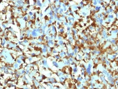 Formalin-fixed paraffin-embedded human Histiocytoma stained with Factor XIIIa Mouse Monoclonal Antibody (F13A1/1448).