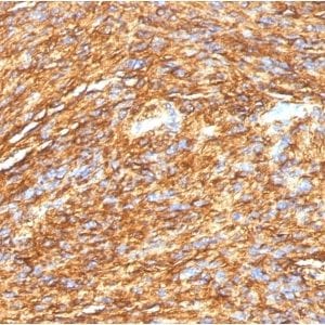 Formalin-fixed paraffin-embedded human GIST stained with DOG-1 Mouse Monoclonal Antibody (DG1/1484).