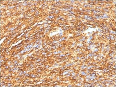 Formalin-fixed paraffin-embedded human GIST stained with DOG-1 Mouse Monoclonal Antibody (DG1/1484).