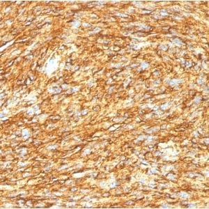 Formalin-fixed paraffin-embedded human GIST stained with DOG-1 Mouse Monoclonal Antibody (DG1/1485).