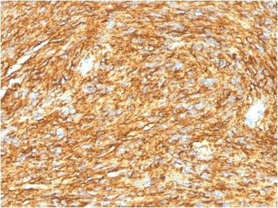 Formalin-fixed paraffin-embedded human GIST stained with DOG-1 Mouse Monoclonal Antibody (DG1/1485).