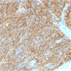 Formalin-fixed paraffin-embedded human GIST stained with DOG-1 Mouse Monoclonal Antibody (DG1/1486).
