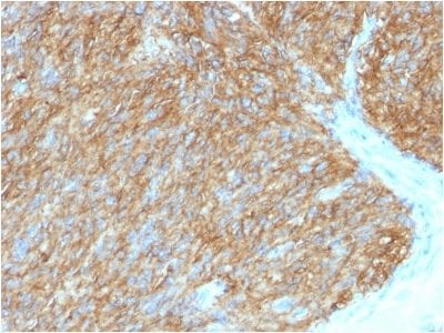 Formalin-fixed paraffin-embedded human GIST stained with DOG-1 Mouse Monoclonal Antibody (DG1/1486).