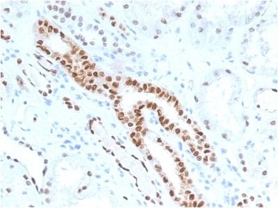 Formalin-fixed paraffin-embedded human Renal Cell Carcinoma stained with PAX8Mouse Monoclonal Antibody (PAX8/1491).