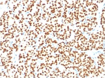Formalin-fixed paraffin-embedded human Thyroidal Carcinoma stained with PAX8Mouse Monoclonal Antibody (PAX8/1491).