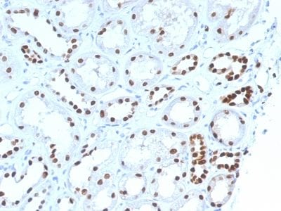 Formalin-fixed paraffin-embedded human Renal Cell Carcinoma stained with PAX8 Mouse Monoclonal Antibody (PAX8/1492).