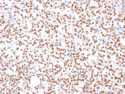 Formalin-fixed paraffin-embedded human Thyroid Carcinoma stained with PAX8 Mouse Monoclonal Antibody (PAX8/1492).
