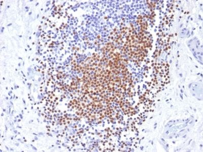 Formalin-fixed paraffin-embedded human Urothelial Carcinoma stained with PAX8 Mouse Monoclonal Antibody (PAX8/1492).