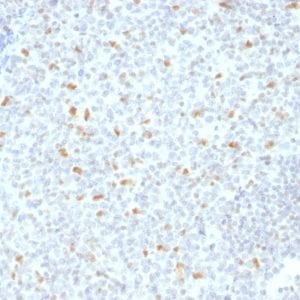 Formalin-fixed paraffin-embedded human Hodgkin’s Lymphoma stained with BCL-6 Mouse Monoclonal Antibody (BCL6/1526).