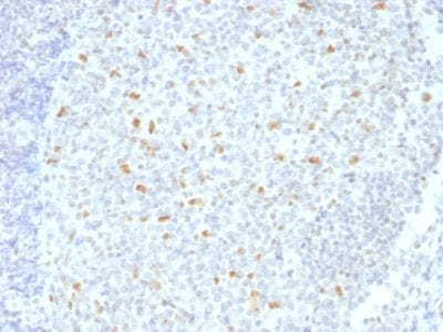 Formalin-fixed paraffin-embedded human Hodgkin’s Lymphoma stained with BCL-6 Mouse Monoclonal Antibody (BCL6/1526).