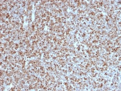Formalin-fixed paraffin-embedded human Follicular Lymphoma stained with BCL-6 Mouse Monoclonal Antibody (BCL6/1527).