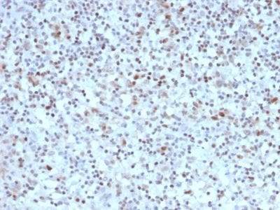 Formalin-fixed paraffin-embedded human Hodgkin’s Lymphoma stained with BCL-6 Mouse Monoclonal Antibody (BCL6/1527).