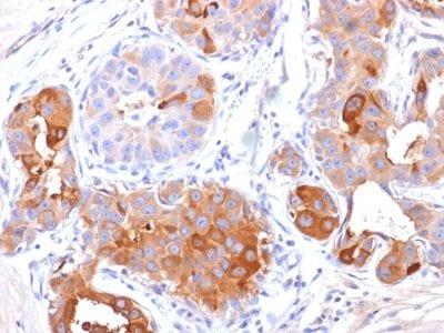 Formalin-fixed paraffin-embedded human Breast Carcinoma stained with GCDFP-15 Mouse Monoclonal Antibody (PIP/1571).